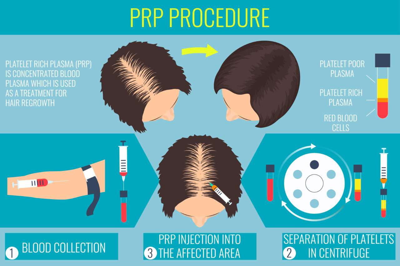 Prp For Hair Loss The Complete Guide D Living Clinic